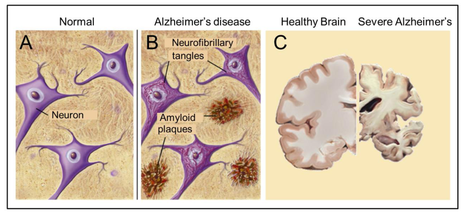阿爾茨海默病的神經基礎